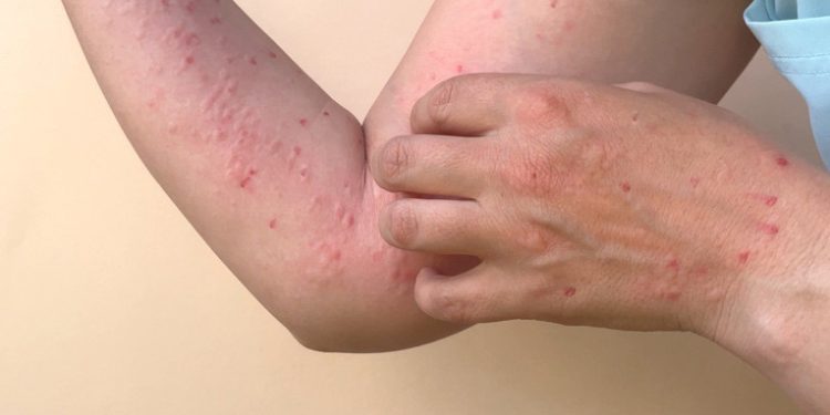 Hingga Oktober Tercatat 14 Kasus Penyakit Zoonosis Cacar Monyet di Indonesia