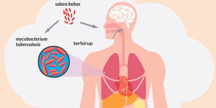 6.949 Kasus Tuberkulosis di Gorontalo, Tempati Peringkat 15 Nasional